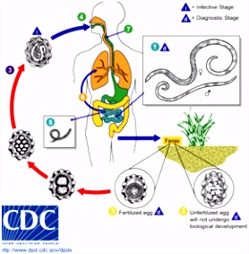 Ascariasis